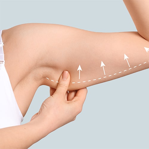 Brachioplasty