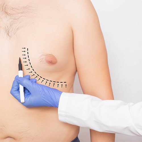 Gynecomastia Treatment
