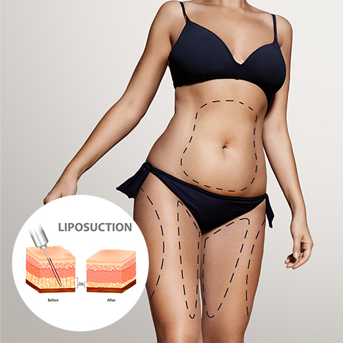Body Contouring with Liposuction