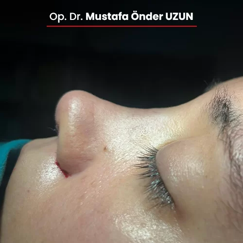 Öncesi Sonrası 1528615879