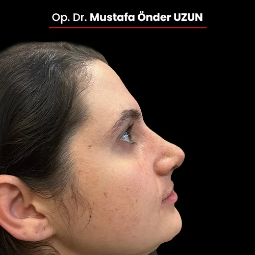 Öncesi Sonrası 1668357277