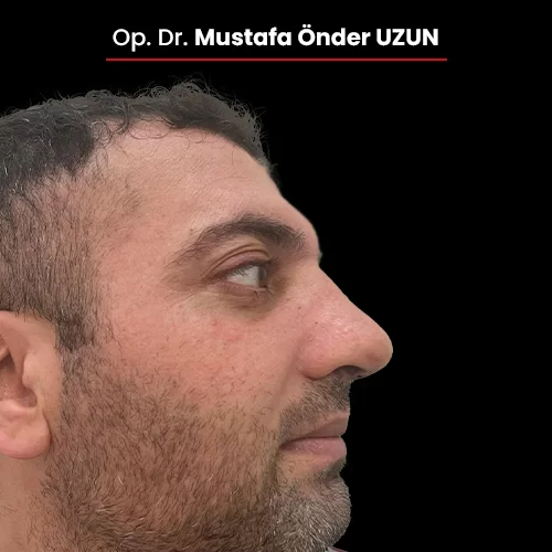 Öncesi Sonrası 2140687231