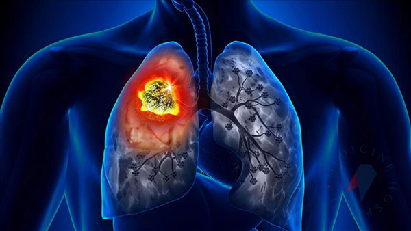 What Is Lung Cancer? Symptoms, Risk Factors, Diagnosis, and Treatment Methods