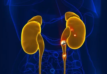 Everything from A to Z About Kidney Stones