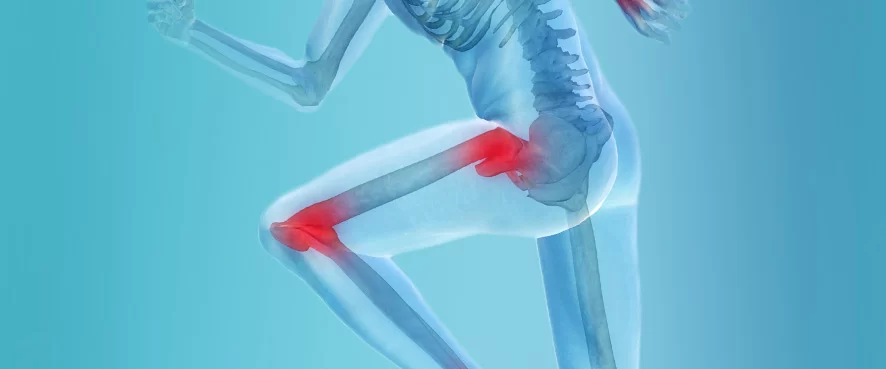 What Is Hip and Knee Joint Replacement?
