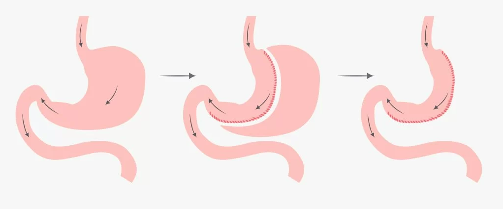 SLEEVE GASTRECTOMY