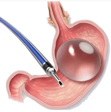 INTRAGASTRIC BALLOON (GASTRIC BALLOON)